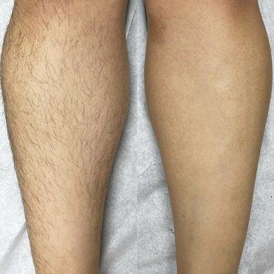 Leg wax before and after