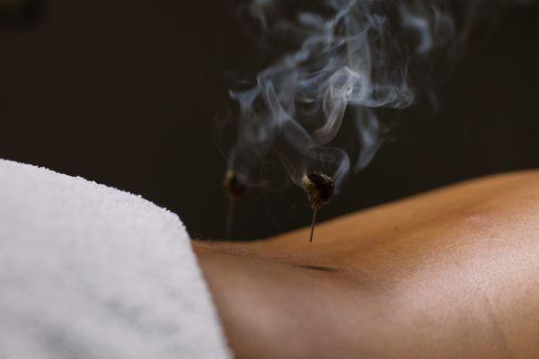 Needle Moxibustion