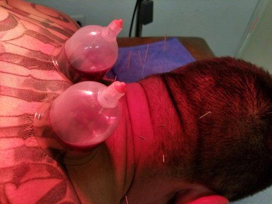 Wet cupping on two old knots in my rhomboids