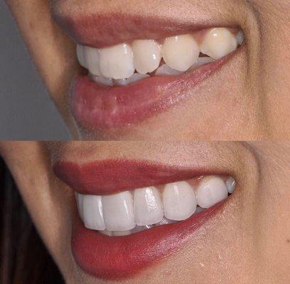 Smile Makeover utilizing Dr. P's Signature veneers!