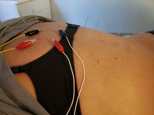 Electroacupuncture medicine for back pains in the spinal region.