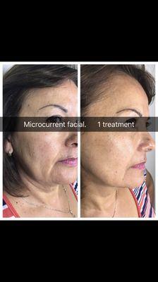 Microcurrent facial treatment