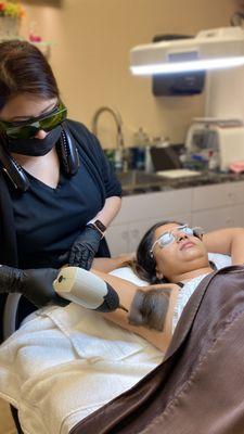 Hollywood Facial or Hollywood Laser Peel for underarm lightening