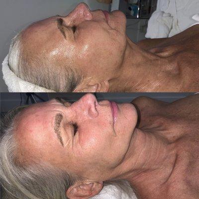 *Facelift Luxur Facial* Before & After