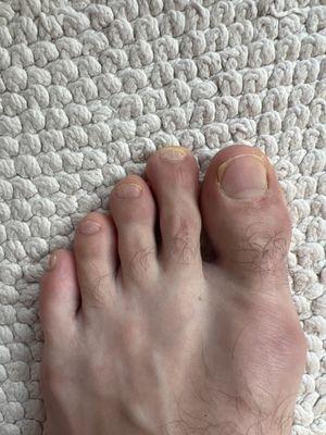 Left foot "pedicure" nails have turned yellow and you can see there is no consistent trimming on nails. Redness in skin under big toe.