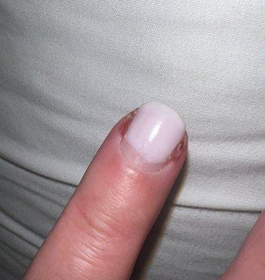 Nail infection after gel manicure