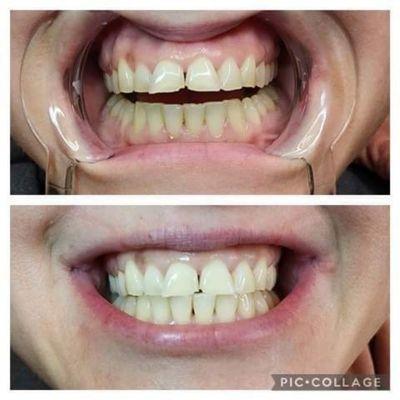 After 1 teeth Whitening session we achieved 5 shades whiter!!