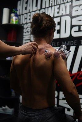 Cupping Therapy