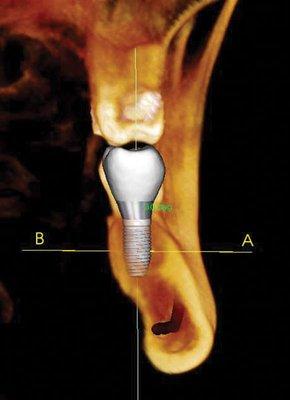 Implant Planning