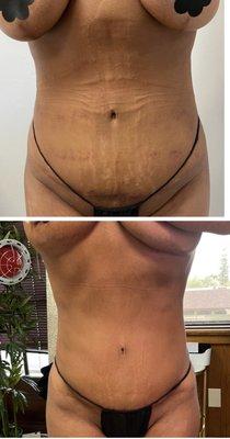 Fresh post op client , 8 weeks later & healing beautifully ! We are still not done !