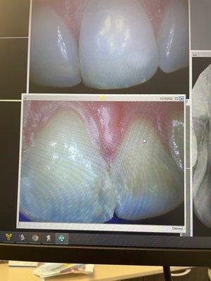 This is not a before picture. It is the AFTER picture of the damage the dentist did drilling too far.