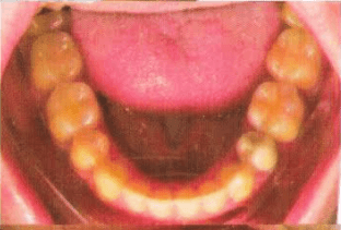 Before starting an orthodontic treatment.