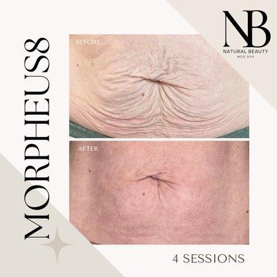 After just 4 sessions of Morpheus8 RF Microneedling on the abdomen.