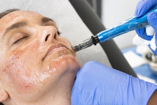 Microneedling sessions stimulate your skin's ability to create its own collagen and elastin- improving evenness + lessening signs of aging!