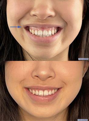 Botox (6-8 units) for gummy smile. It can last around 8 weeks. Done by nurse Holly Ngo (Phuong)