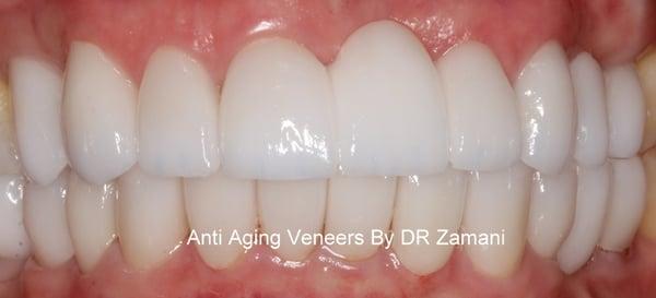 After Porcelain Bridge/Veneers