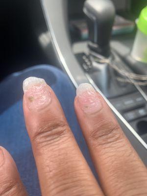 Nail fungus 2 days after visiting this horrible place.