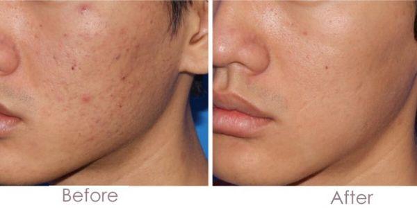 Microneedling Before and After