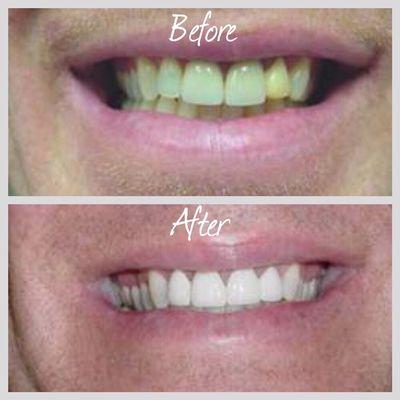 Teeth whitening services