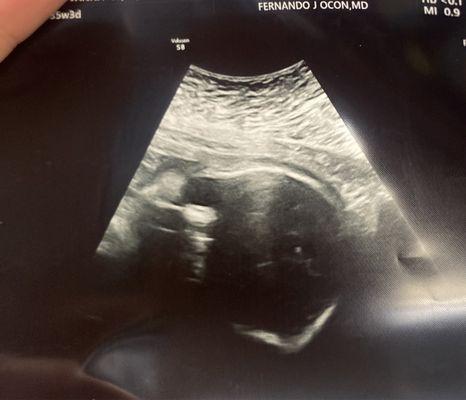 this is supposedly my baby's "face". Does anyone see a FACE in this ultrasound.