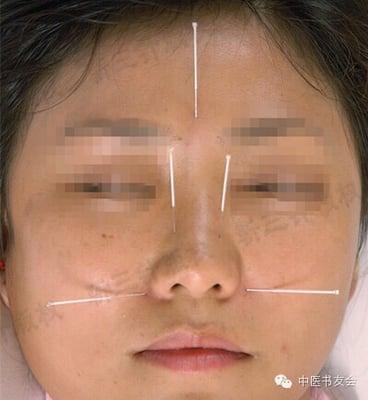 Acupuncture for sinus