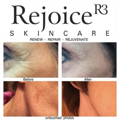 Rejoice R3 Skincare  before and after