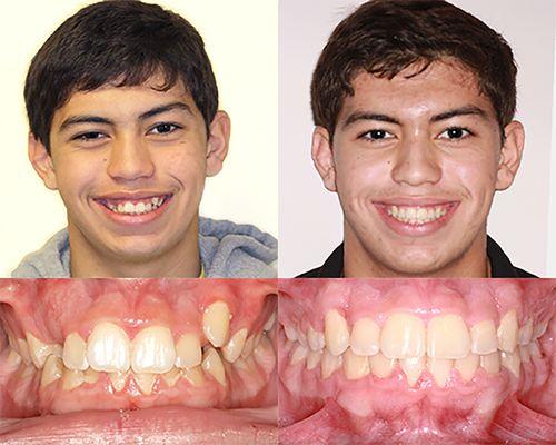 After a year of treatment, Vaughn Glen's orthodontic treatment is completed!