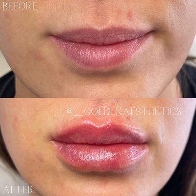 Before and after lip filler