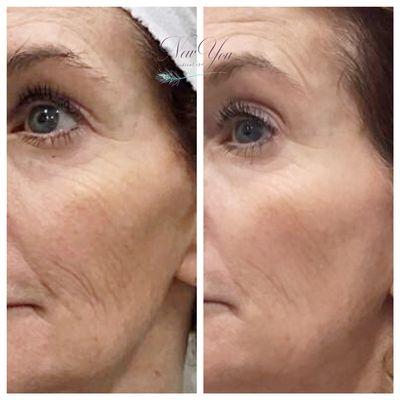 Sculptra for crepey skin, accordion lines, collagen induction.