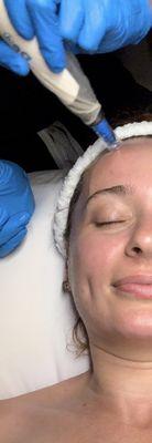 Micro-needling treatment