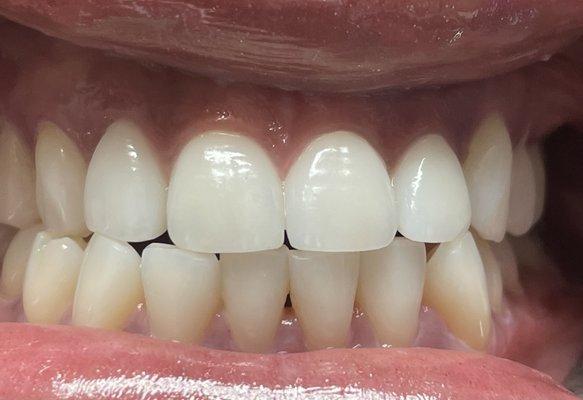 Four beautiful zirconia crowns!!