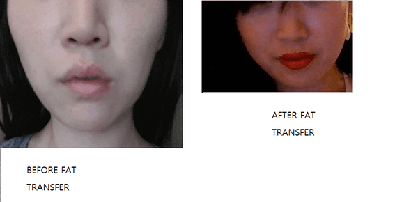 MY BEFORE AND AFTER PICTURES OF FAT TRANSFER. I AM NORMAL AGAIN. THANK YOU DR. BULLIS