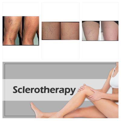 #spiderveinstreatment #spiderveins #varicose #várices