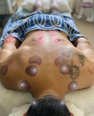 Acupuncture