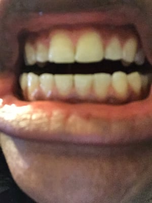 My teeth lol