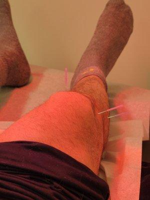 Acupuncture on knee with heat lamp.