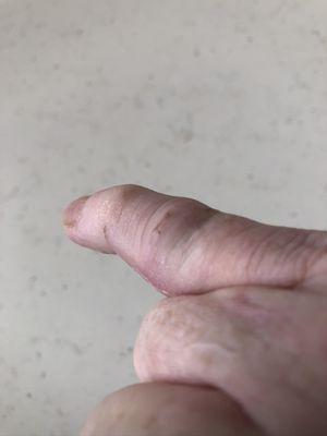 Finger in initial 5 weeks. ( Now almost complete range of motion, and looks great 8 mos later after Hand Surgeon repair