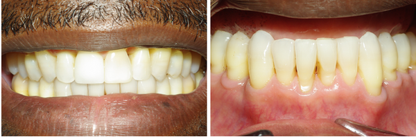 Ricky completed his treatment in 7 months.  Please note how the severe crowding on the bottom teeth was resolved...