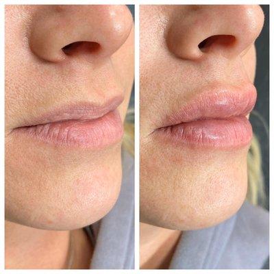 lip filler with Hyloron Pen or injections depending on results desired