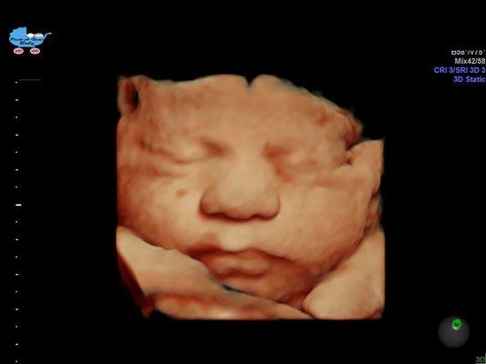 HD 4D image of baby in 3rd trimester