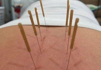 Dry Needling