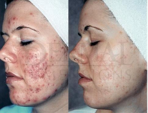 Acne and scar improvement.