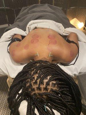 Traditional fire cupping and acupuncture