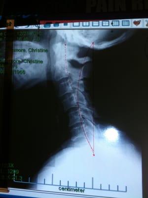 My first visit x-ray.  Curved line shows where my neck is supposed to be. Dotted line shows where mine is. Get yours corrected!