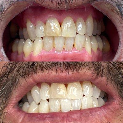 LED TEETH WHITENING