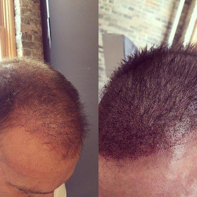 Client had hair replacement therapy and now with me for density treatment