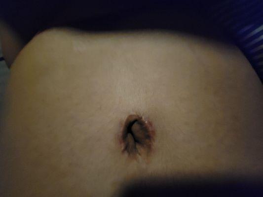 Damaged belly button (9.5 mo after surgery)