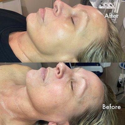 One Procell treatment result.