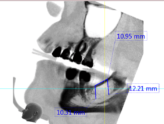 Bone graft, block grafting, dental, dental implant, oral surgeon, Beverly Hills, Dr. Paul Anstey, Board Certified, implant surgery