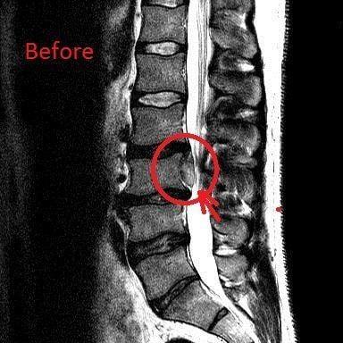 Pre-treatment MRI showing severe herniation of lumbar disc.